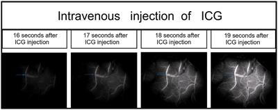 Application of intraarterial superselective indocyanine green angiography in bypass surgery for adult moyamoya disease